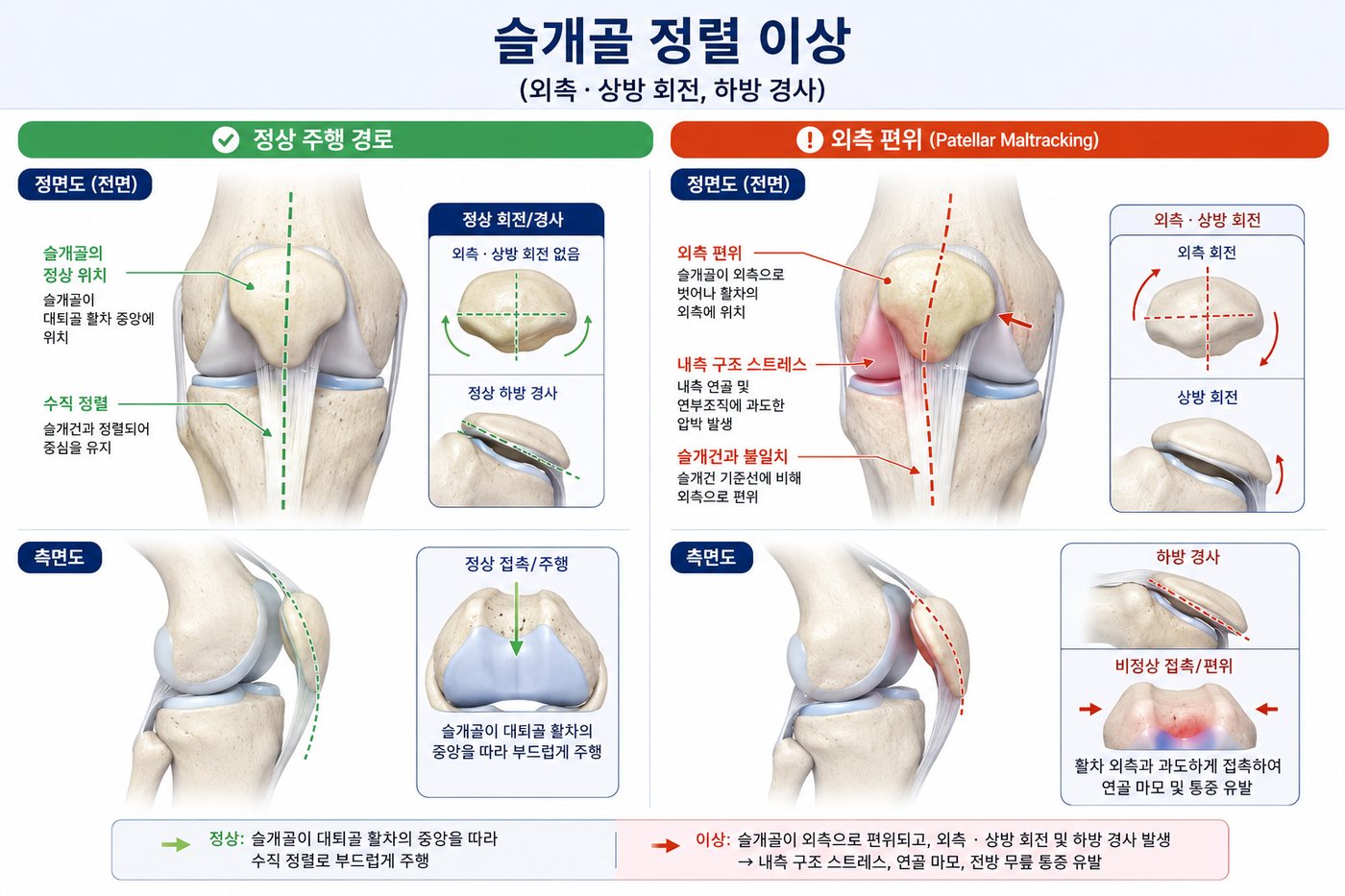 Illustration comparing a normally tracking kneecap with one shifted outward