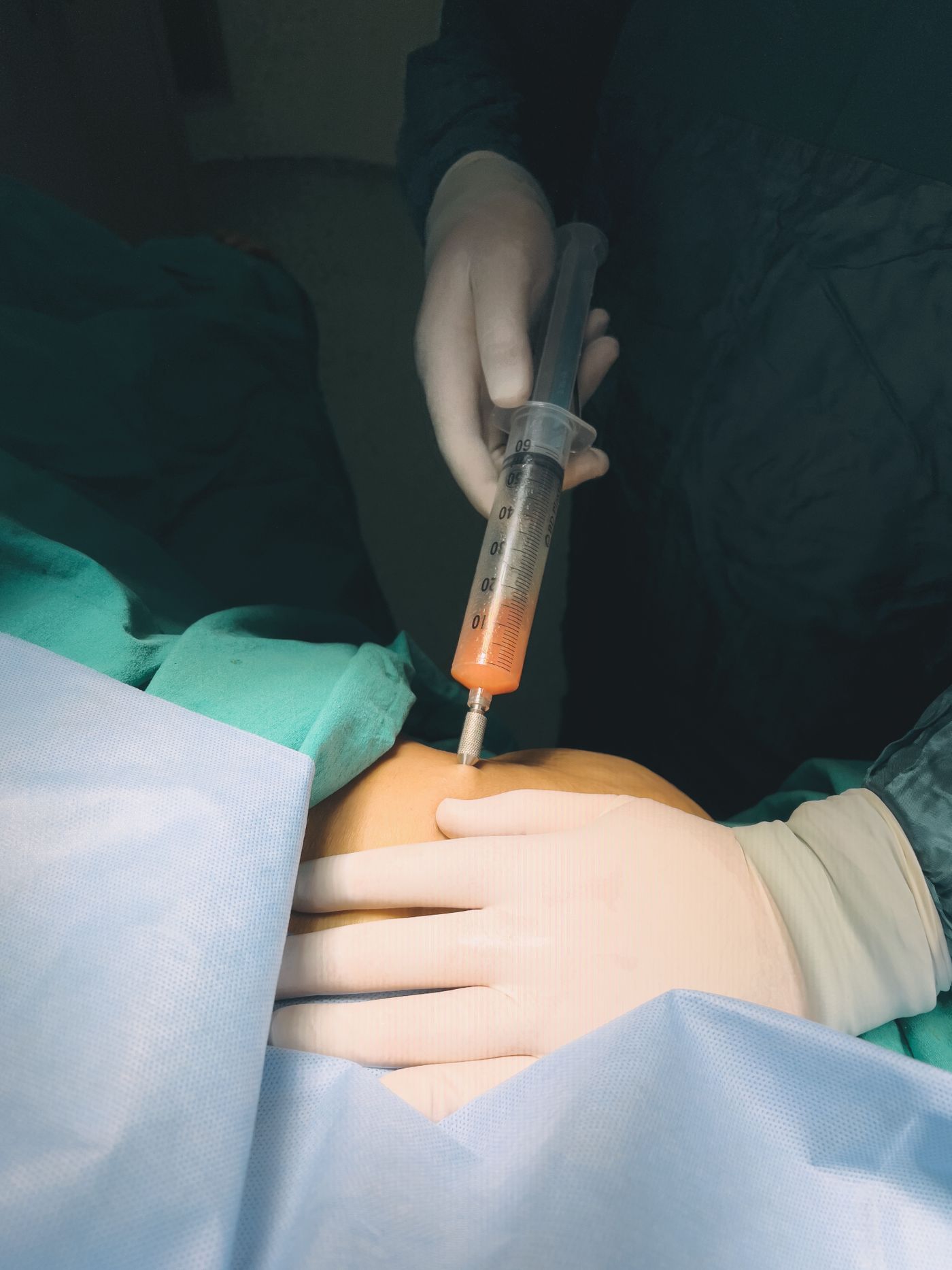 A joint injection on a sterile surgical drape (staged photo)
